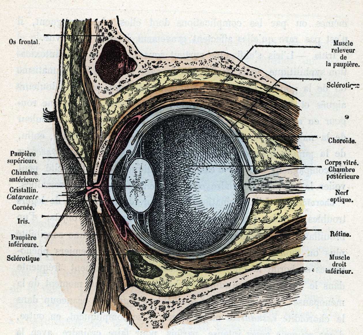 Corte vertical de un globo ocular con catarata Grabado de "Nature and Man" de Rengade 1881 Colección particular de Alphonse Demarle