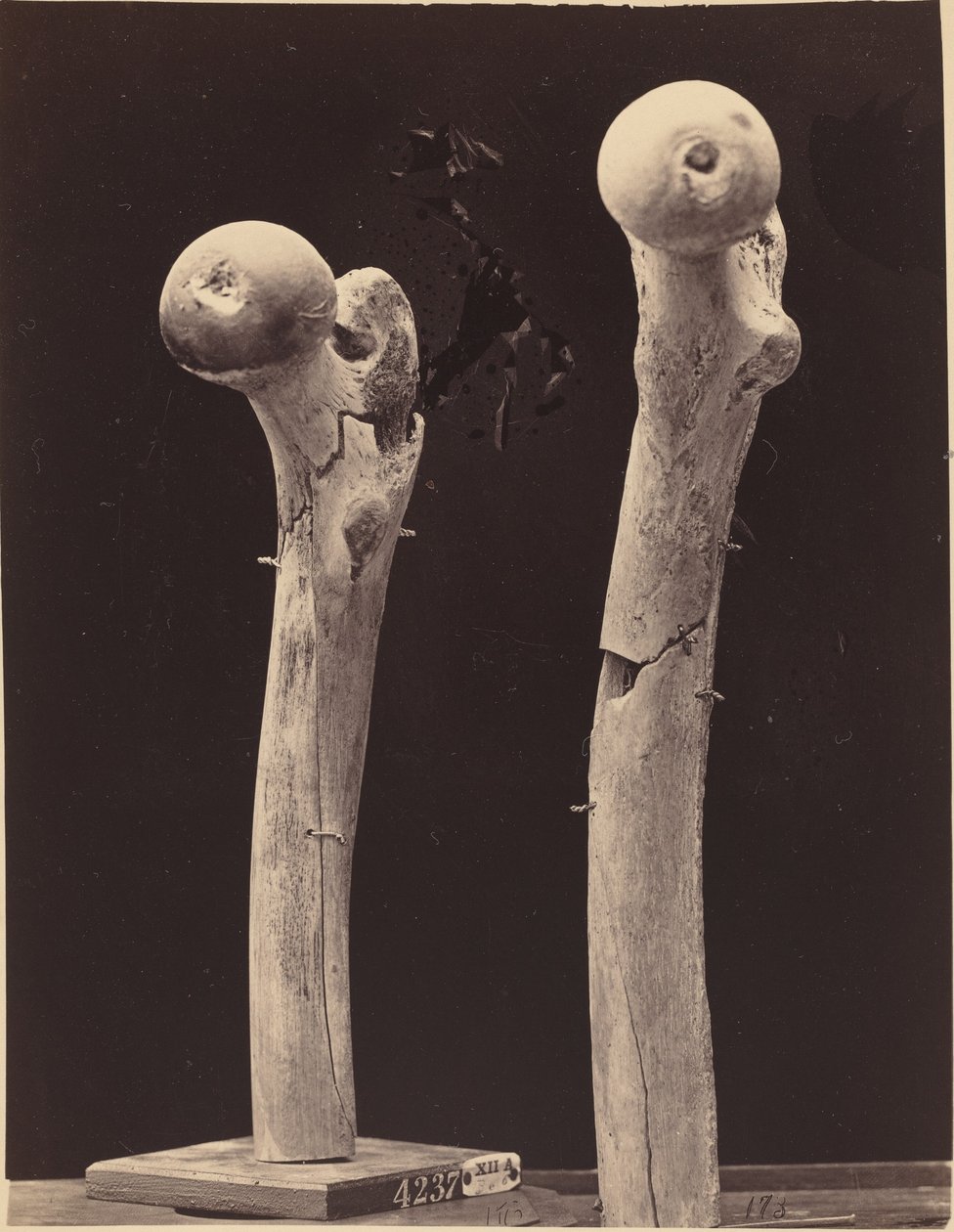 Especímenes de fracturas de fémur por disparo de American 19th Century