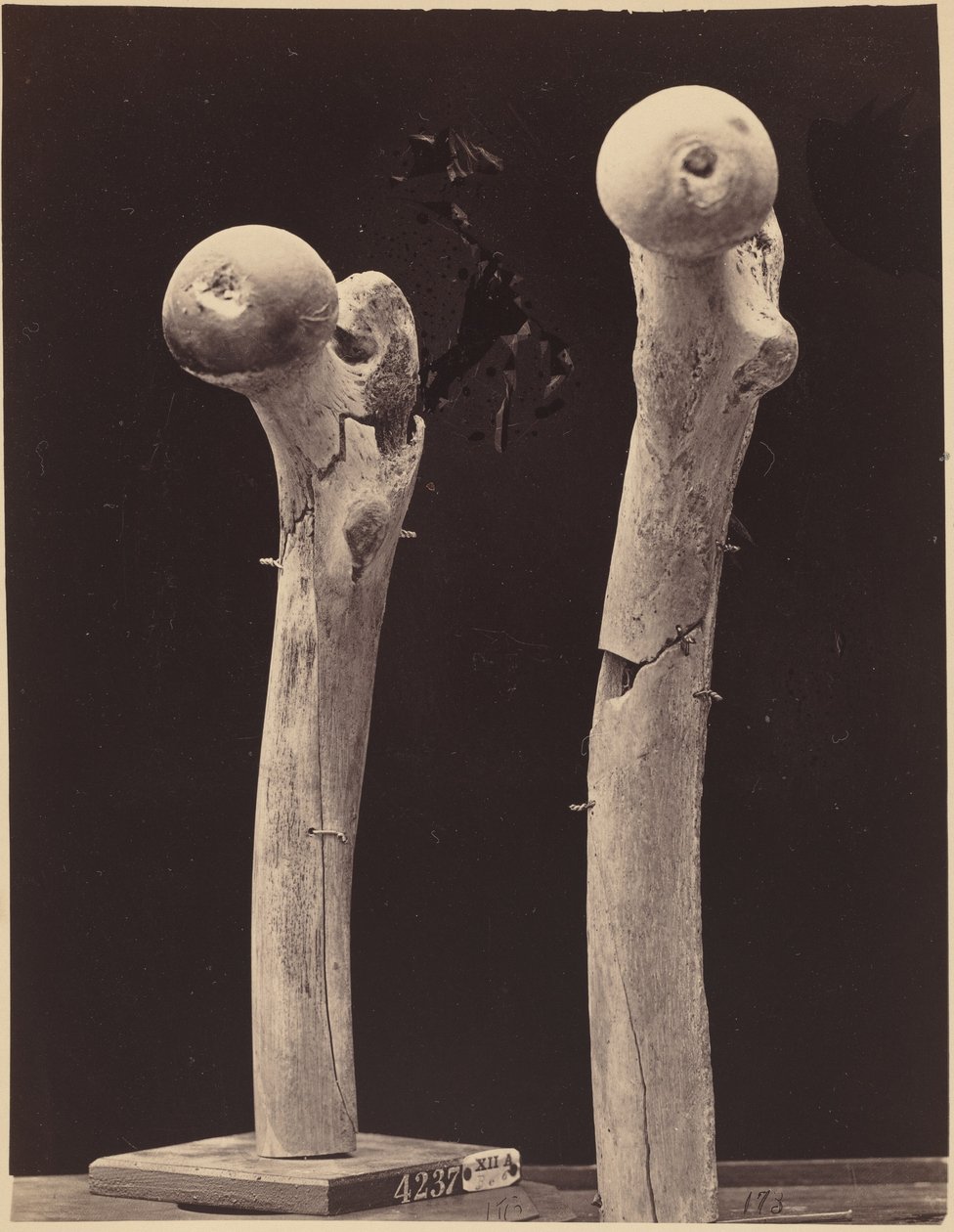 Especímenes de fracturas de fémur por arma de fuego,c. 1867 (foto) de American Photographer