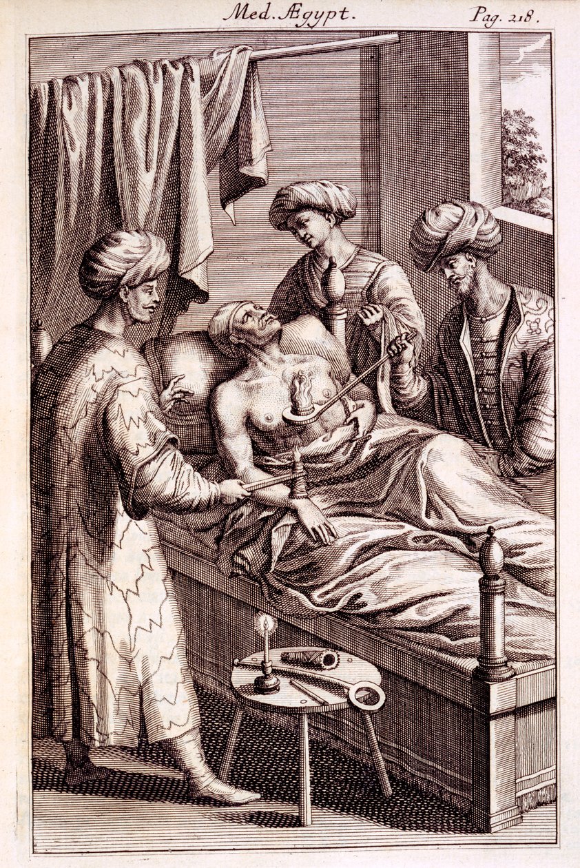 Ilustración de moxibustión de Medicina Aegyptorum por Prospero Alpinus, 1745 de American School