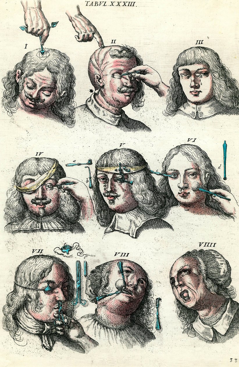 Cirugía en el siglo XVIII: Trepanación y operación del ojo y la cara. Grabado en 