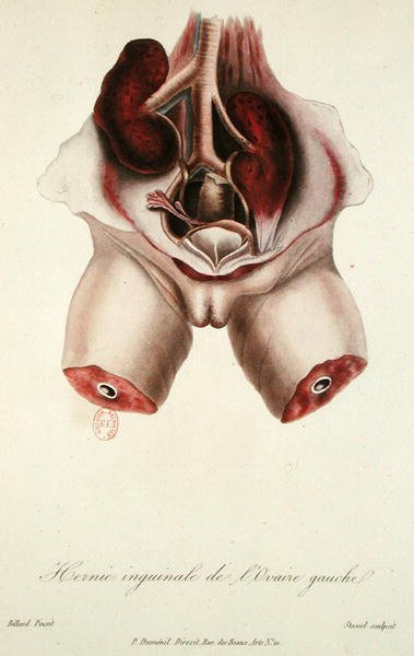 Hernia inguinal del ovario izquierdo, de 