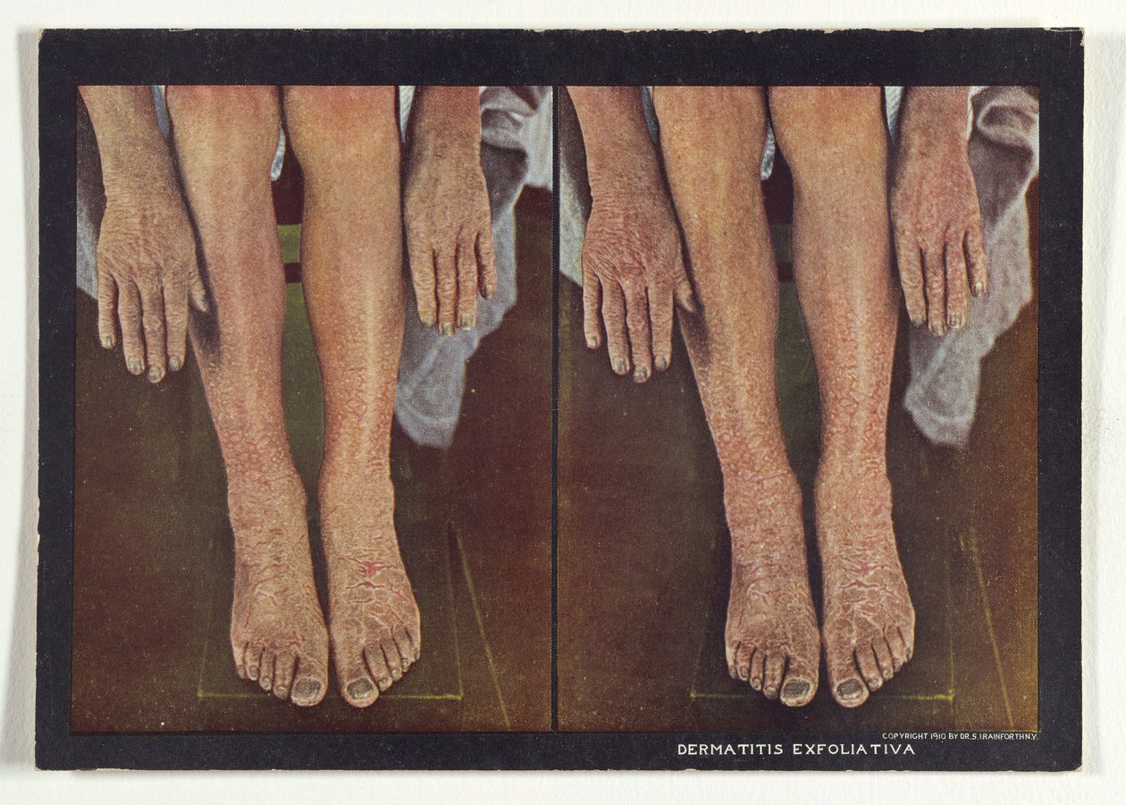 Dermatitis exfoliativa de Dr. Selden I. Rainforth