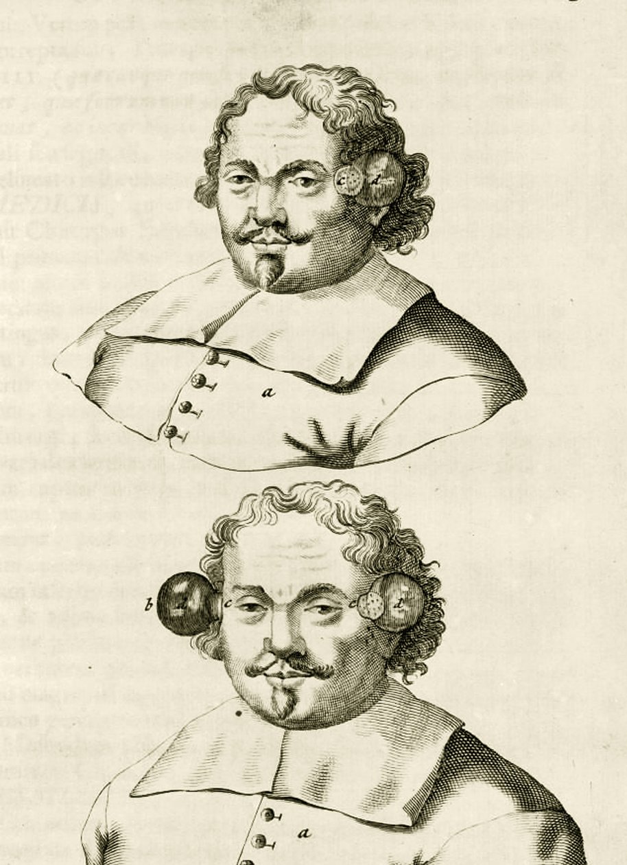 Un ejemplo de ventosas, de Exercitationes Practicae circa Medendi Methodum por Frederik Dekkers, 1694 de Dutch School