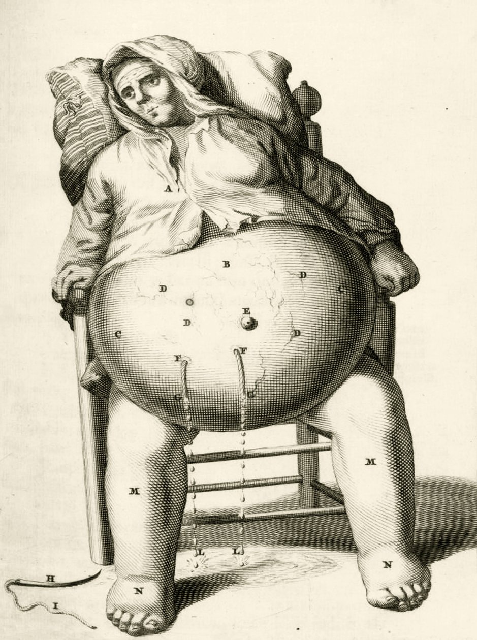 Drenando líquidos de un absceso, de Exercitationes Practicae circa Medendi Methodum por Frederik Dekkers, 1694 de Dutch School