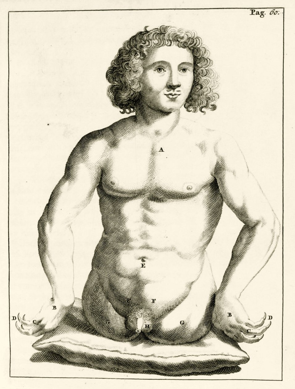 Ejemplo de defectos congénitos, de Exercitationes Practicae circa Medendi Methodum por Frederik Dekkers, 1694 de Dutch School