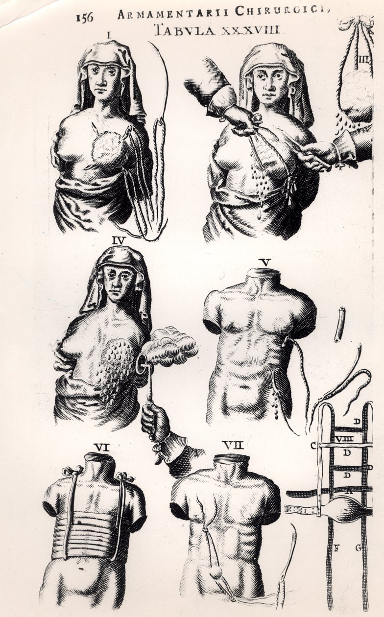 Operación de cáncer de mama, de Armamentarii Chirurgici por Johannes Schultes (1595-1645) publicado en Ámsterdam, 1672 de Dutch School
