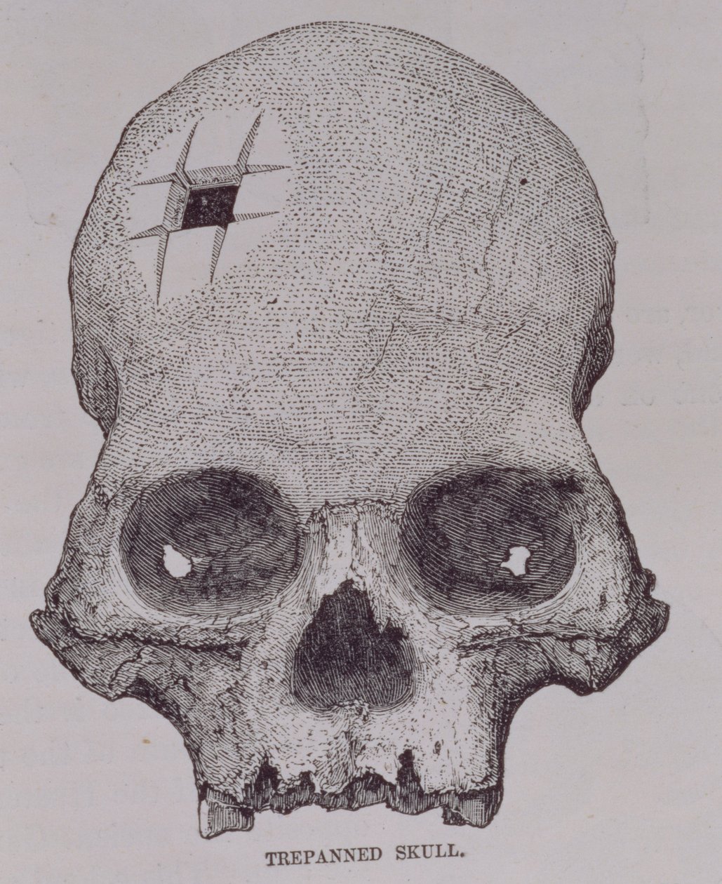 Cráneo trepanado, de 