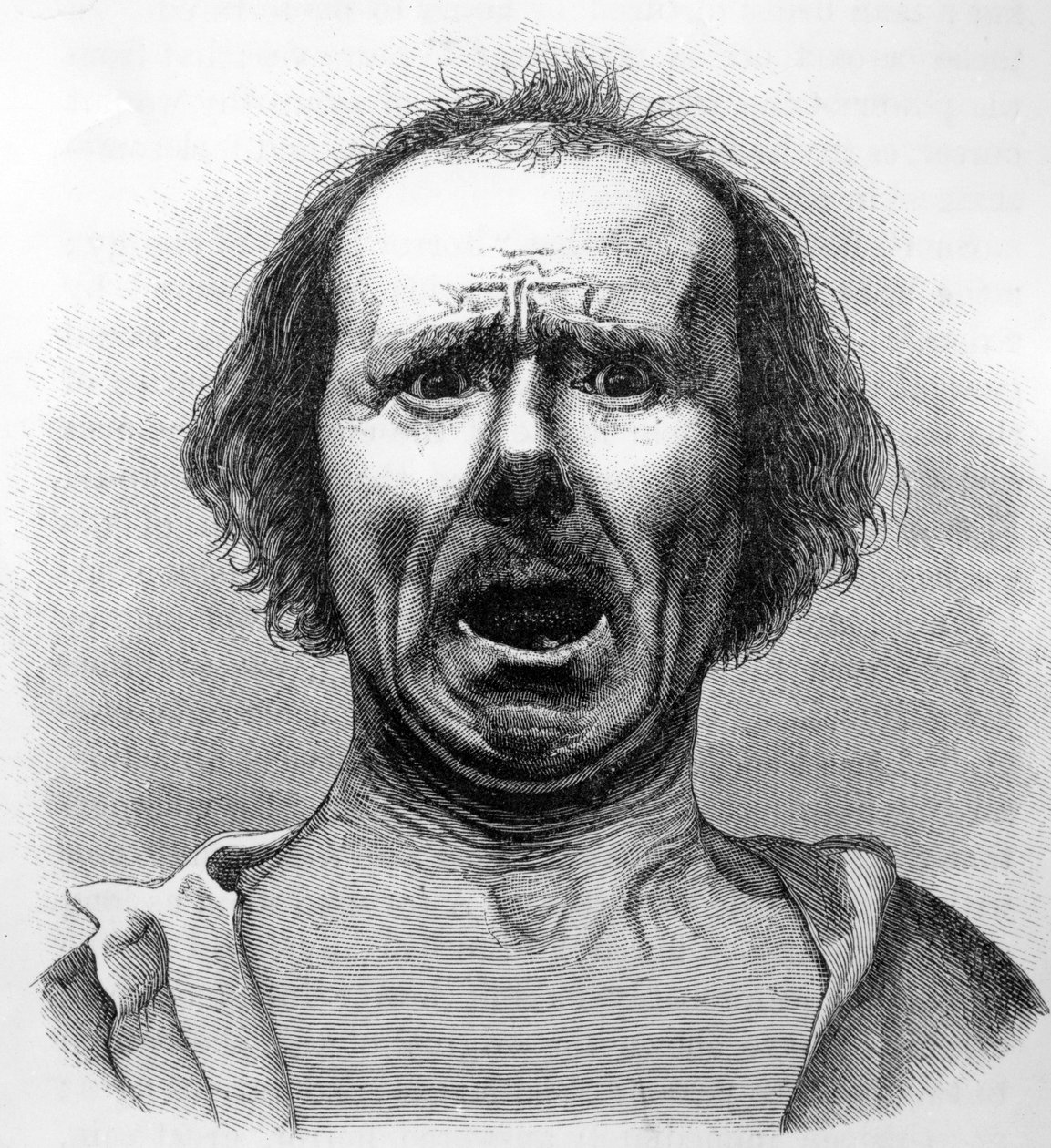 Horror y Agonía, copiado de una fotografía del Dr. Duchenne, ilustración de 