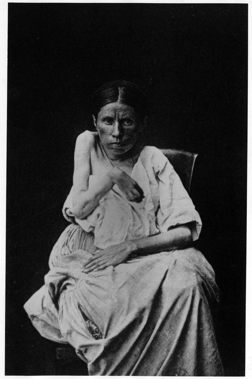 Fotografía de un paciente que sufre de epilepsia hemipléjica, en “iconografía fotográfica de la Salpetrière, Bourneville y P. Regnard, París de French Photographer