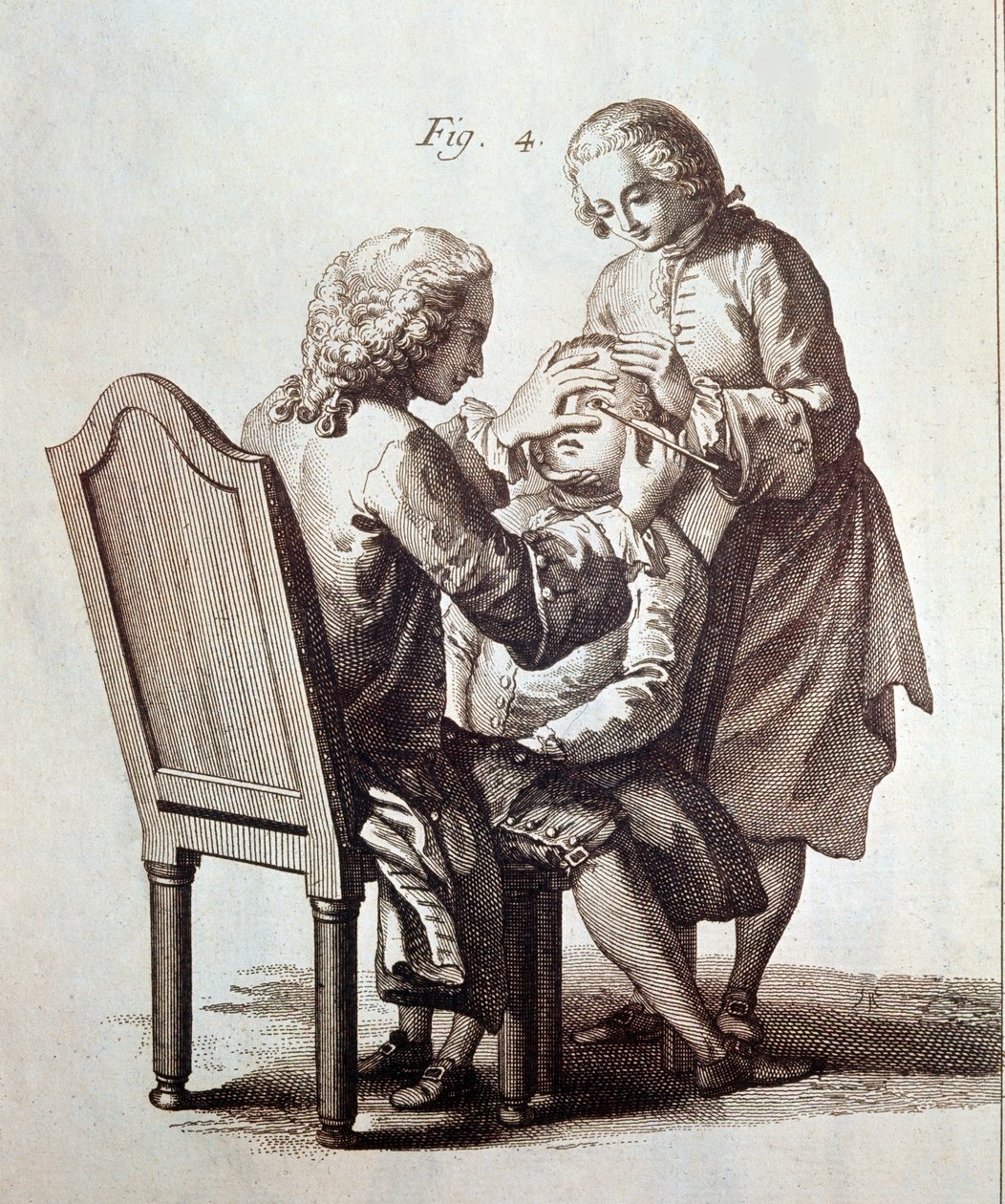 Un médico operando a un paciente de cataratas, ilustración de la Enciclopedia Médica de Denis Diderot y Jean le Rond d