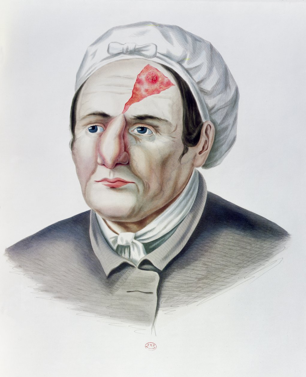 Después de una operación de injerto de piel, de Selecta Praxis Medico-Chirurgica por Alexander Auvert, París, 1856 de French School