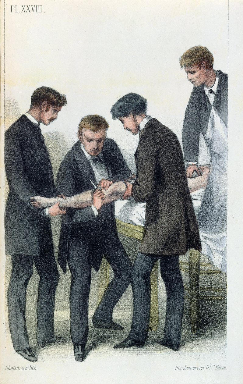 Amputación de un brazo, de un manual médico por Jean-Baptiste-Leon Dubreuil, c.1850-60 de French School