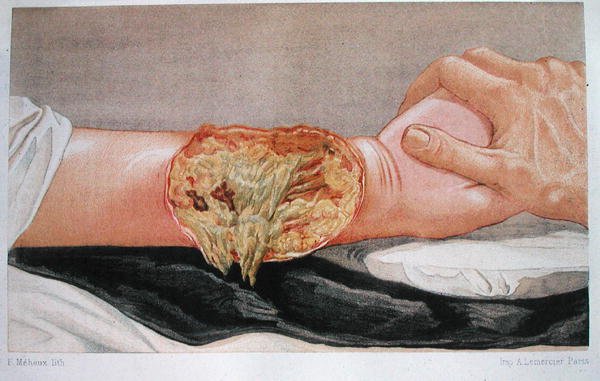 Gangrena hospitalaria, de 