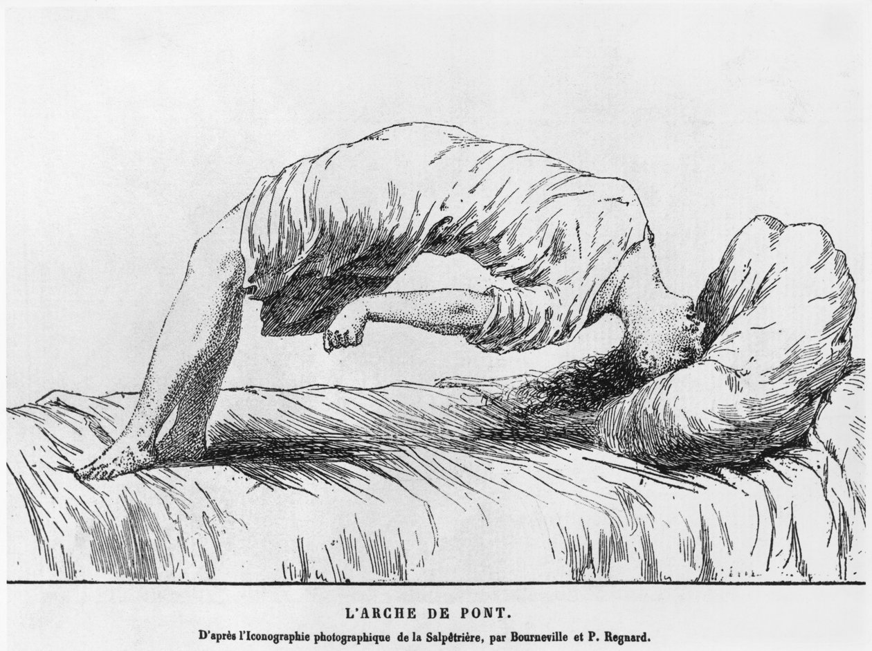 Histeria y sonambulismo, de Les Maladies Epidemiques de l