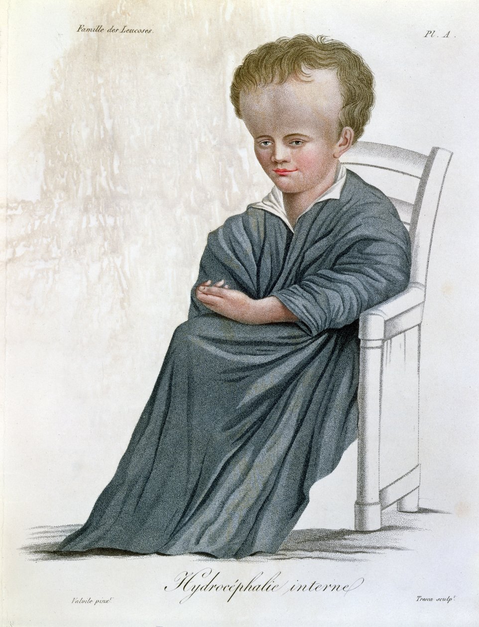 Hidrocefalia interna, de Nosologie Naturelle por Baron Jean Louis Alibert (1768-1837) grabado por Tresca, 1817 de French School