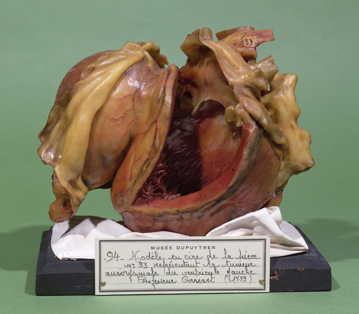 Modelo de un tumor del ventrículo izquierdo, 1799 de French School