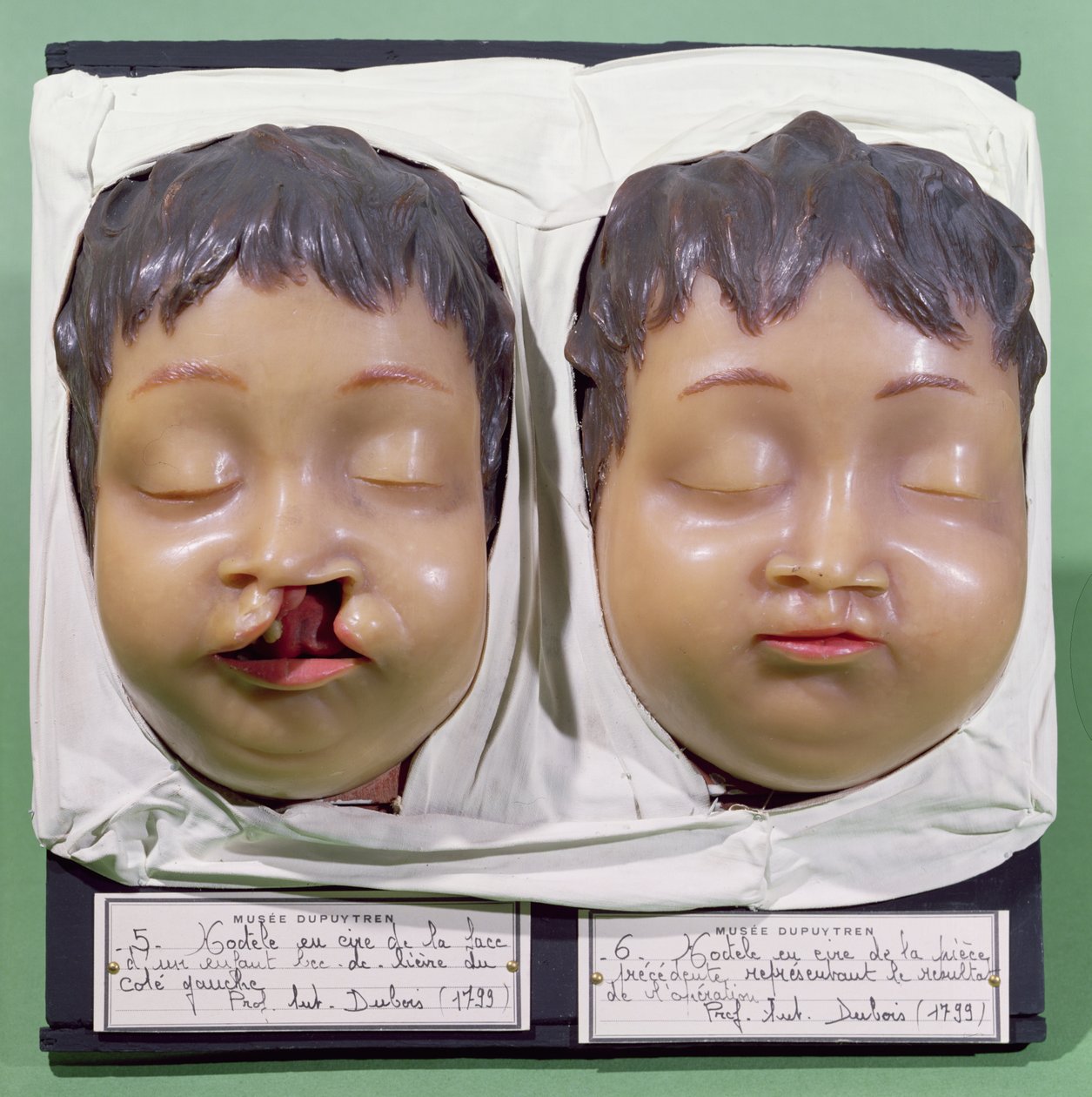 Modelo que muestra el rostro de un niño antes y después de una operación para corregir un labio leporino realizada por Antoine Dubois (1756-1837) en 1799 de French School