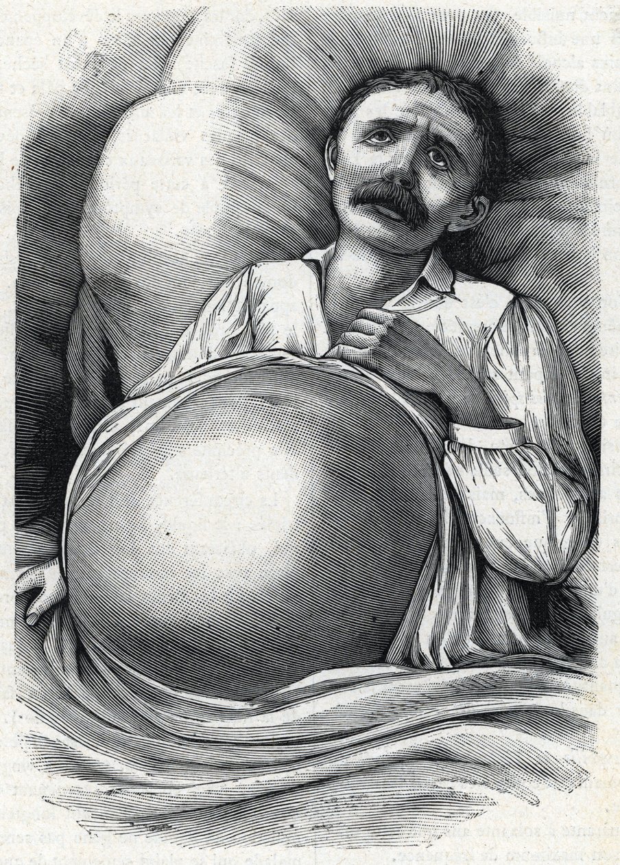 Paciente con cirrosis hepática avanzada (grabado) 1888 de French School