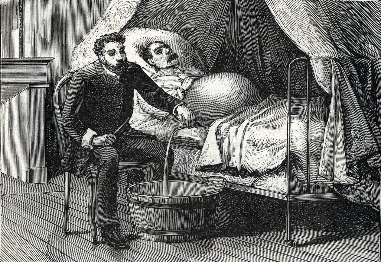 Paciente con cirrosis hepática avanzada, doctor realizando una punción (grabado) 1888 de French School