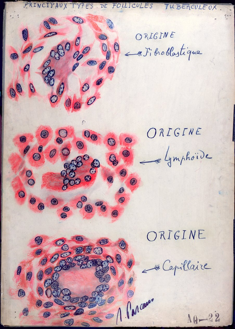 Folículos tuberculosos principales de French School