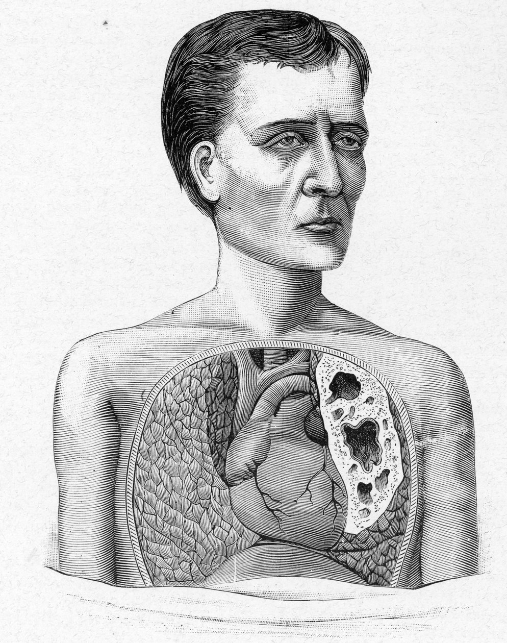 Representación de una persona con cavernas, complicación de tuberculosis (grabado) de French School