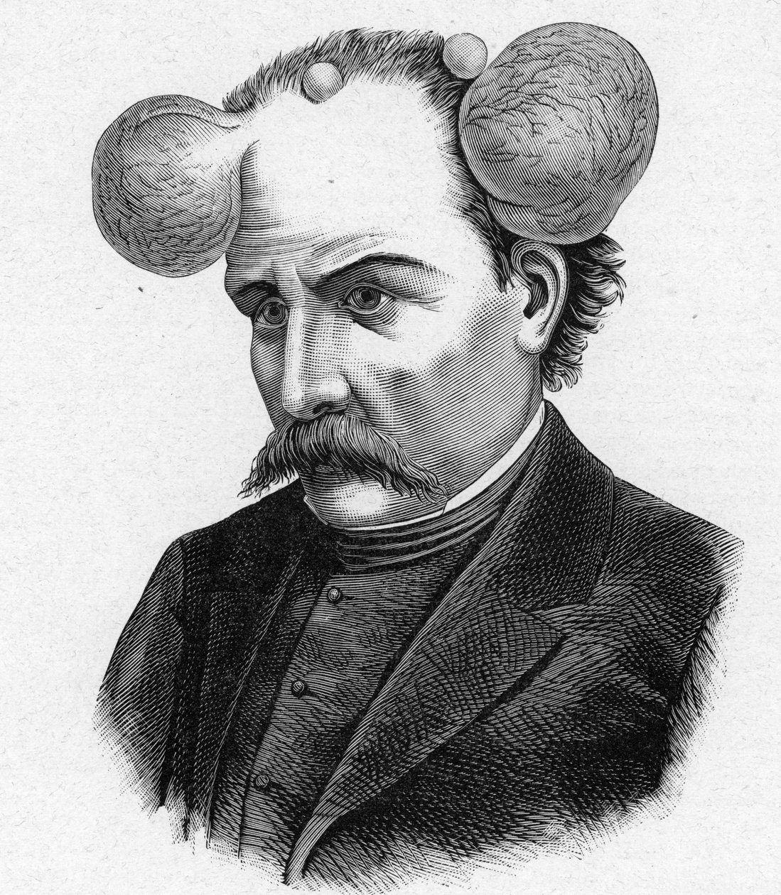 Representación de una persona con lupa, quistes en el cuero cabelludo (grabado) de French School