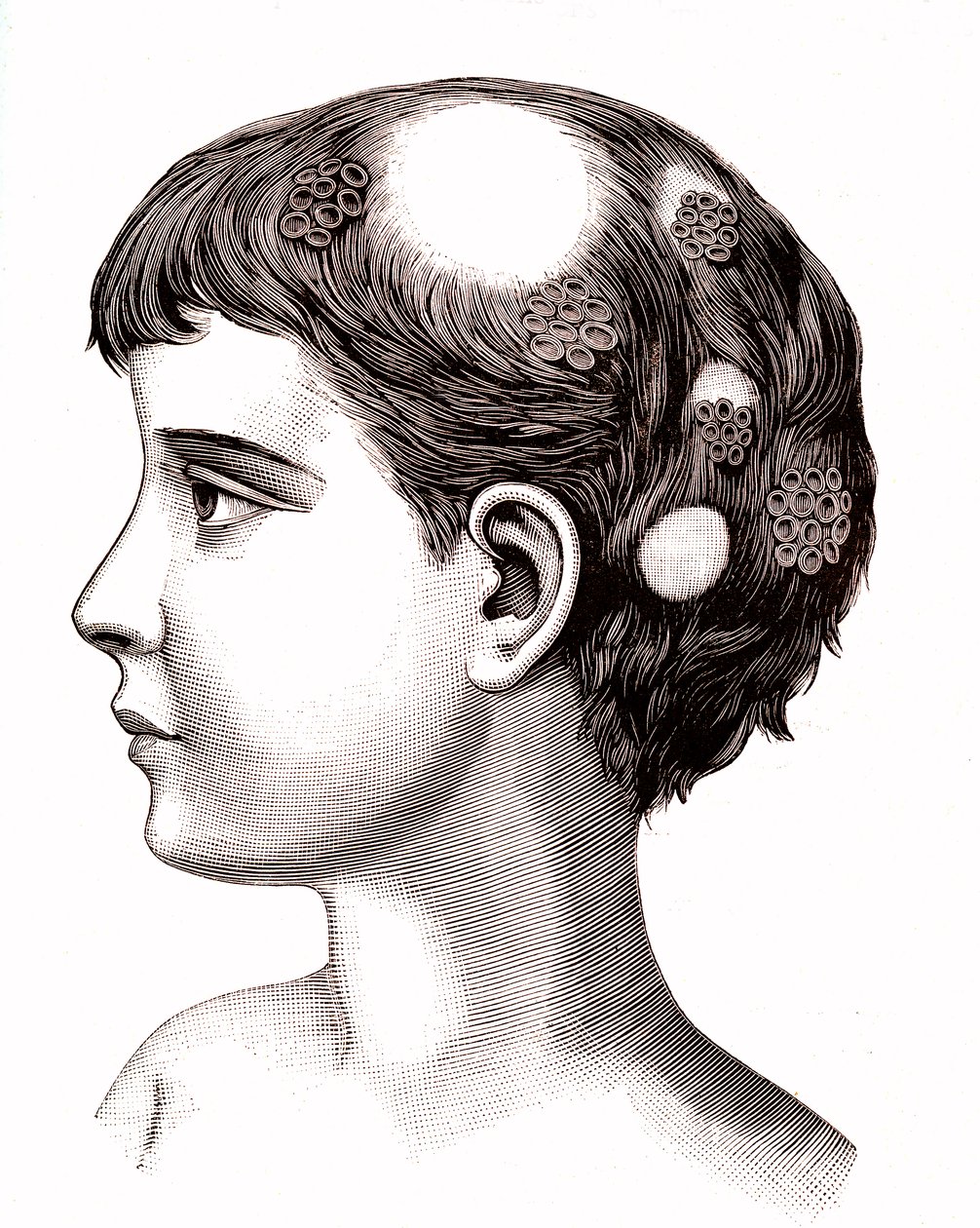Tiña en un niño. 1887 (grabado) de French School