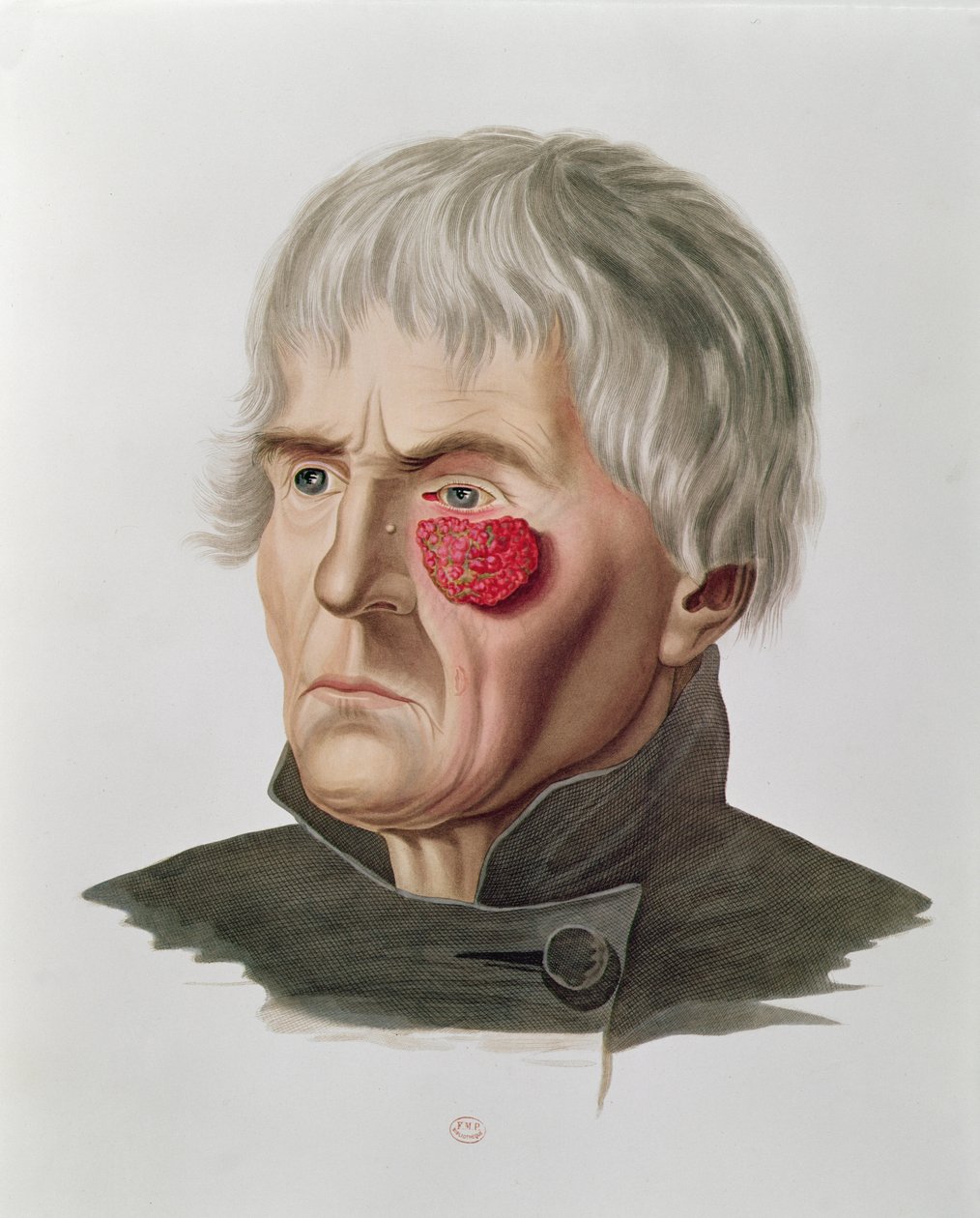 Enfermedad de la piel antes de una operación, de Selecta Praxis Medico-Chirurgica por Alexander Auvert, París, 1856 de French School
