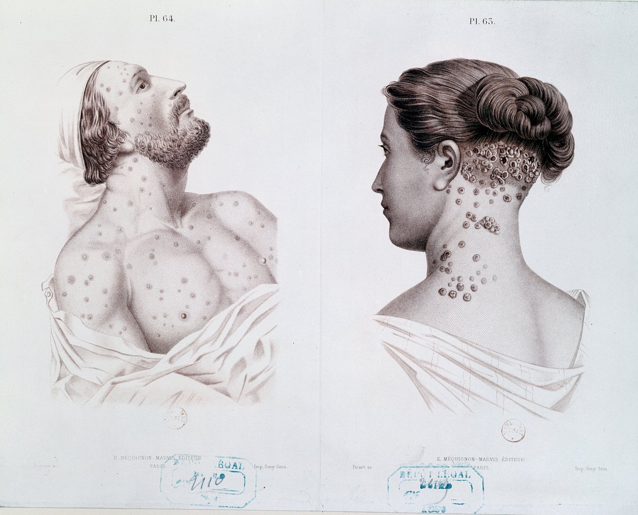Síntomas de sífilis en hombres y mujeres, de un libro médico, c.1850-60 de French School