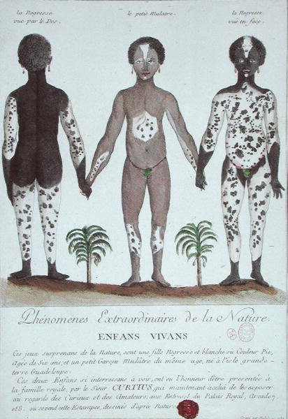 El fenómeno del vitíligo de French School
