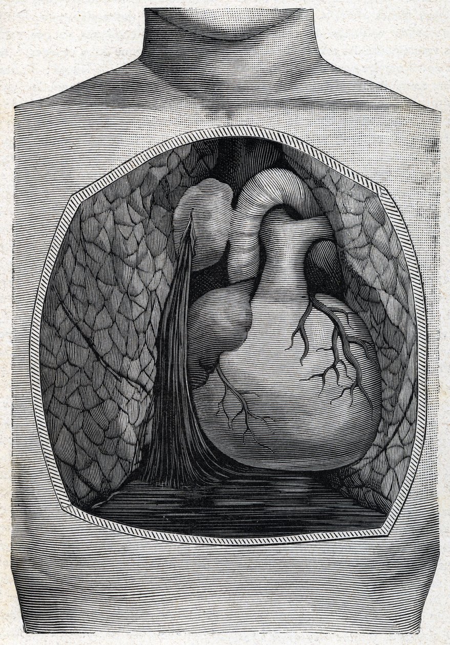 Ruptura de aneurisma, 1888 de French School