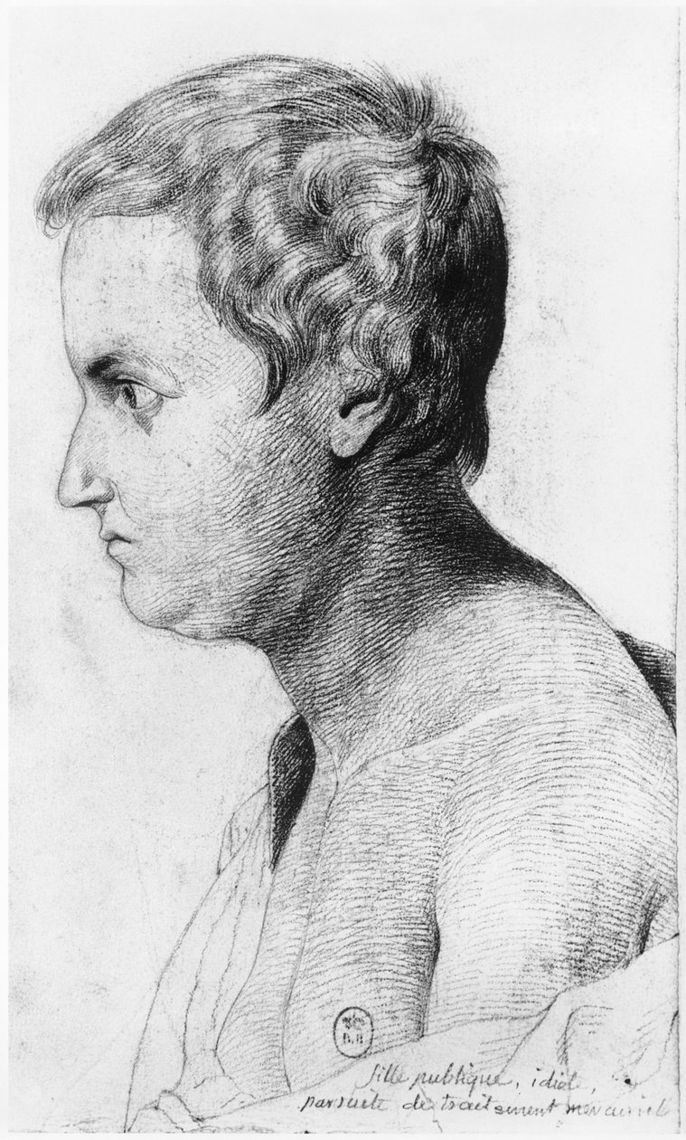 Prostituta idiota que sufre de sífilis, ilustración de un tratado inédito de Jean Etienne Dominique Esquirol (1772-1840) sobre los lunáticos del asilo Salpetriere, c.1818 de Georges Francois Gabriel