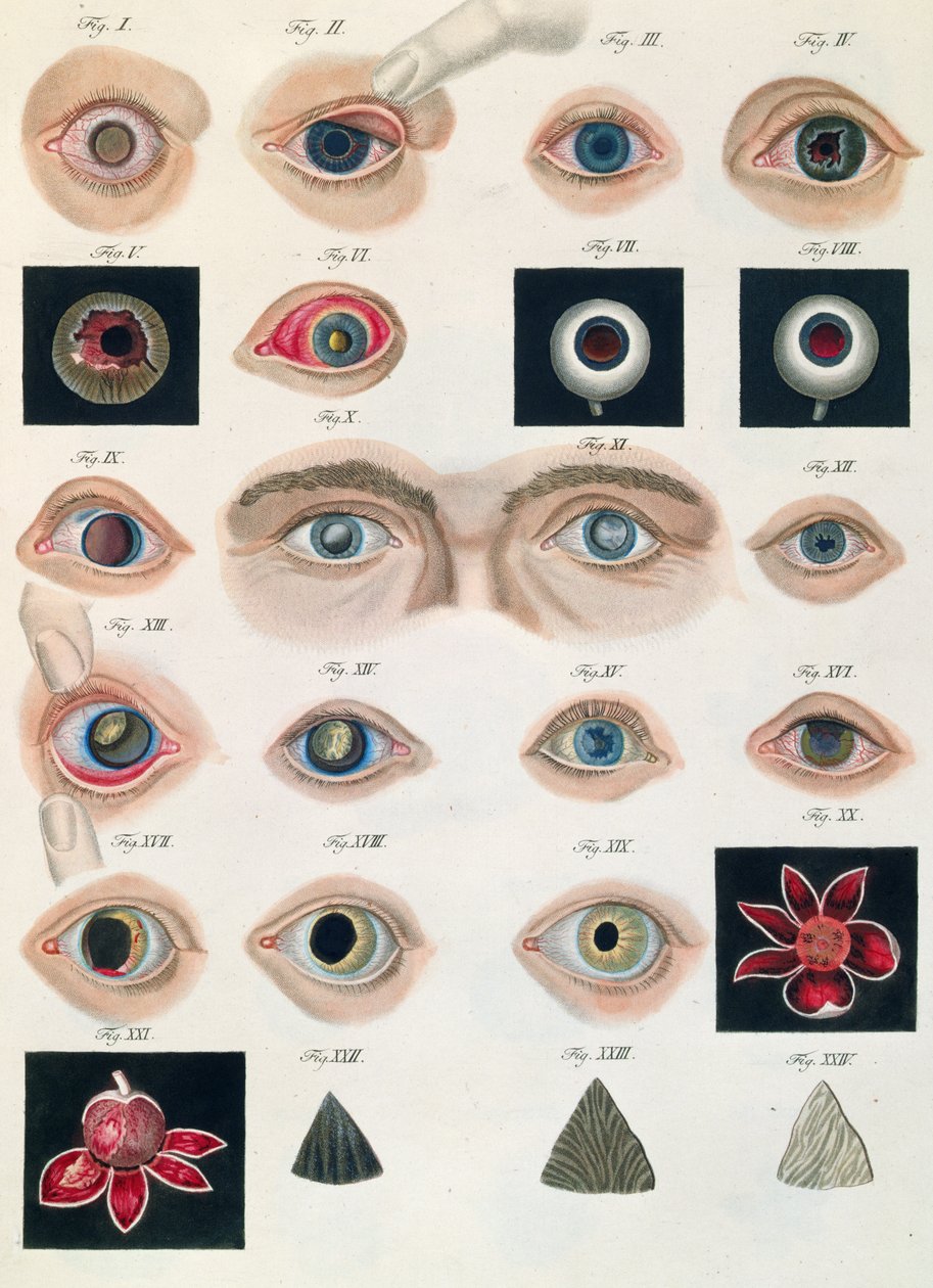 Descripción de anomalías congénitas del ojo, de Klinische Darstellungen der Krankheiten und Blidungsfehler des Menschlichen Auges, por Friedrich August von Ammon (1799-1861) 1838 de German School