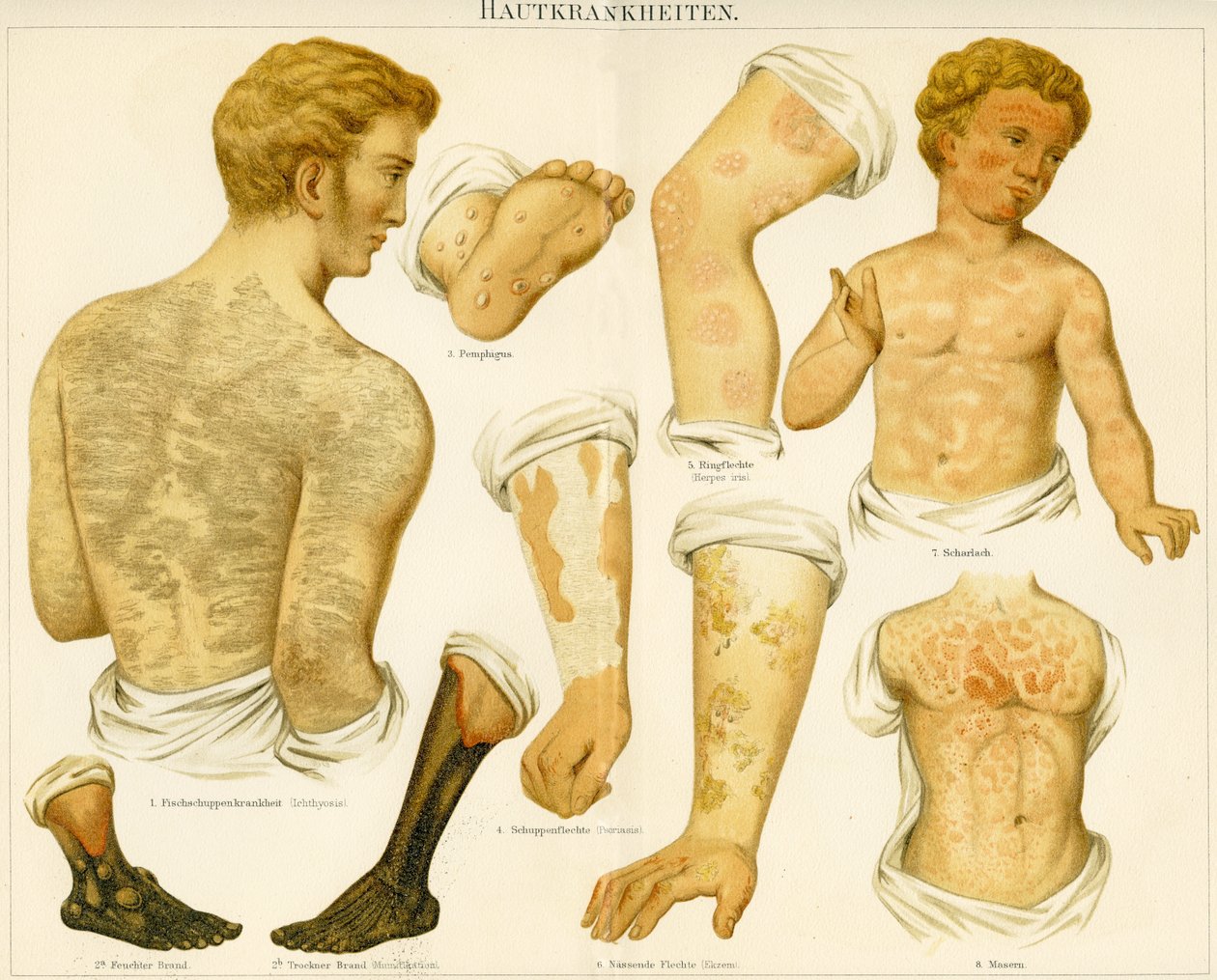Trastornos de la piel, c.1890 de German School