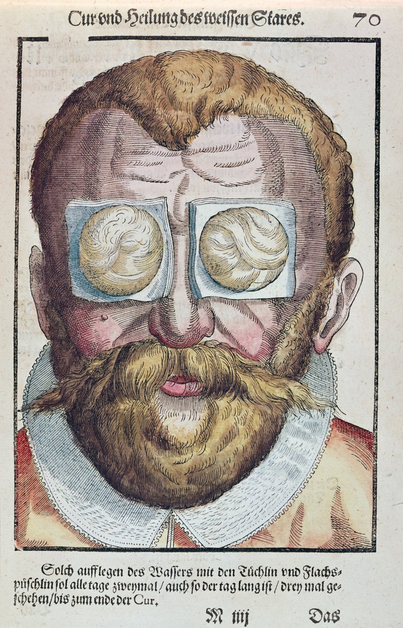 Tratamiento de una afección ocular, de Ophthalmodouleia por Georg Bartisch (1535-1636) publicado en Dresde en 1583 de German School
