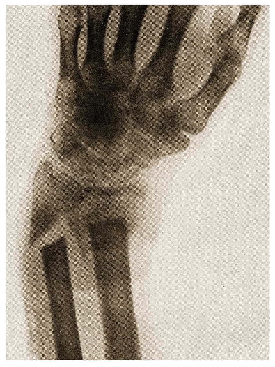 Radiografía de una muñeca fracturada c.1890 de German School
