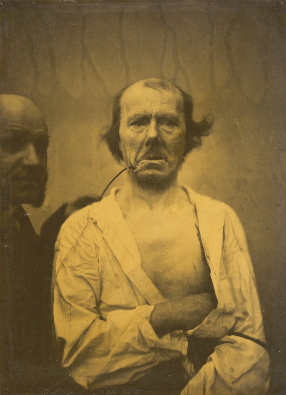 Una expresión relajada (izquierda); Disgusto (derecha),1854-1856, impreso 1862 (foto) de Guillaume Benjamin Armand Duchenne de Boulogne