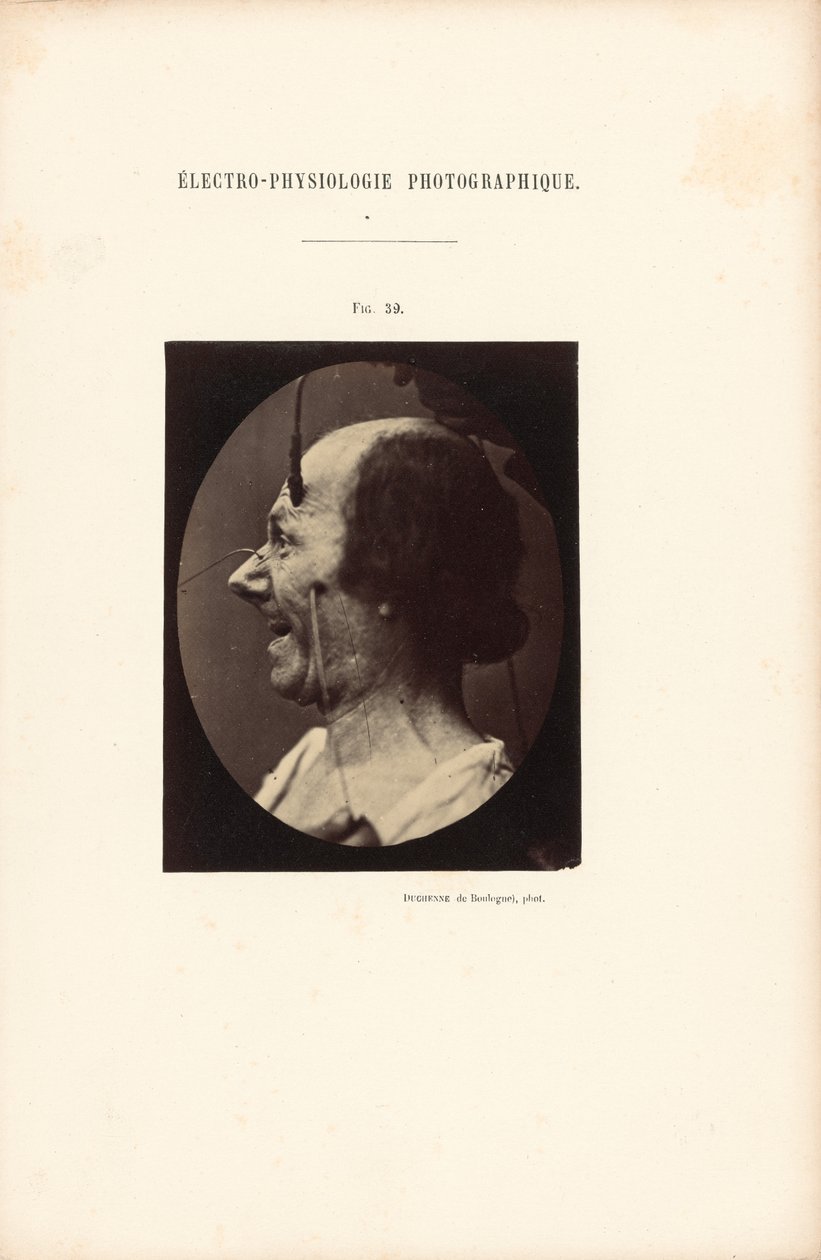 Electrofisiología fotográfica, Figura 39 de Guillaume Benjamin Duchenne