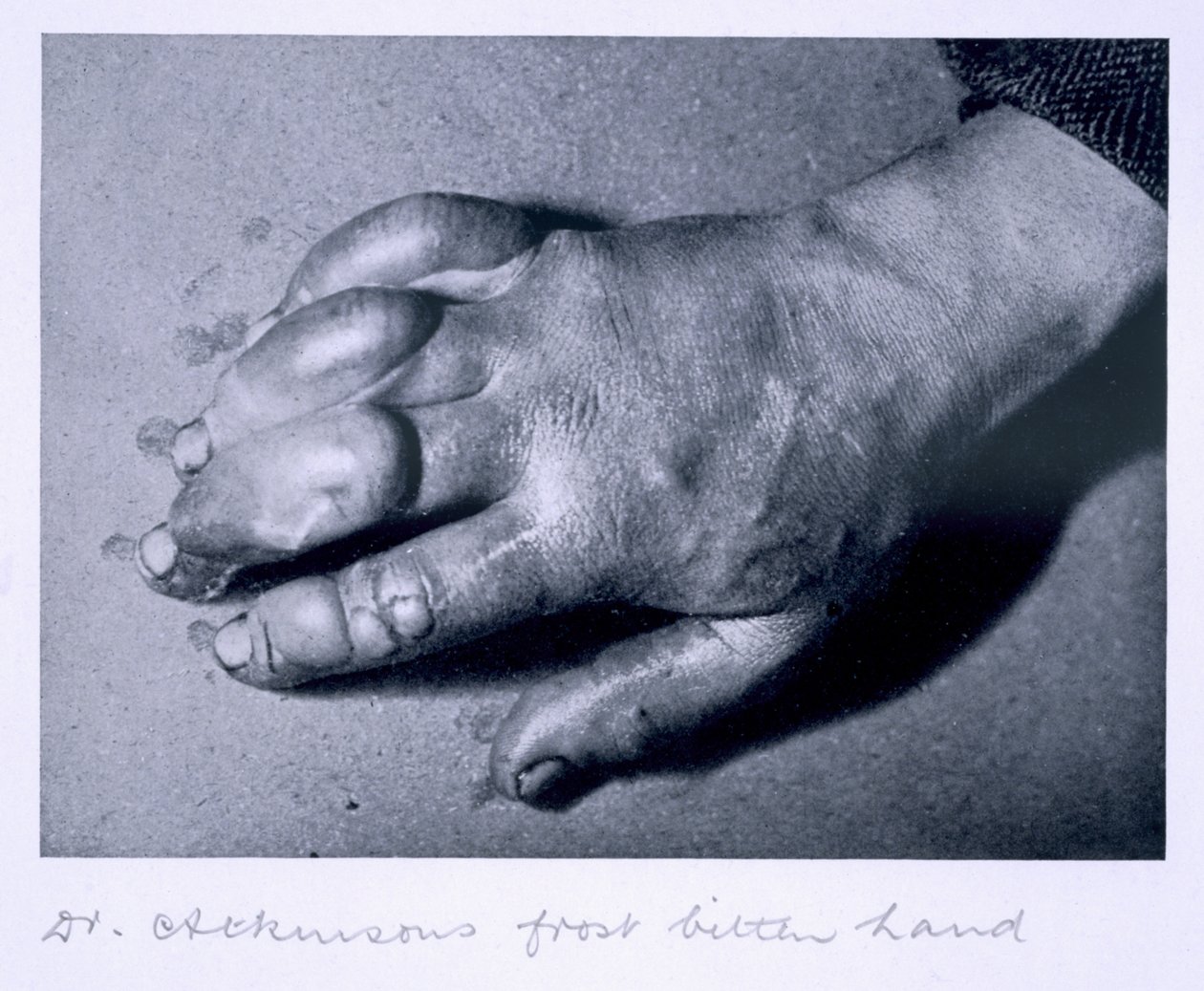 La mano congelada del Dr. Atkinson, 1911 de Herbert Ponting