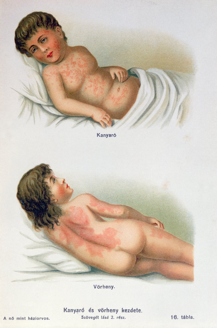 Sarampión y escarlatina, de un libro médico familiar, c.1900 de Hungarian School