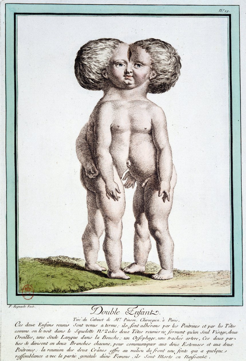 Niños siameses - en “Las desviaciones de la naturaleza” por Régnault de Jean Baptiste Regnault