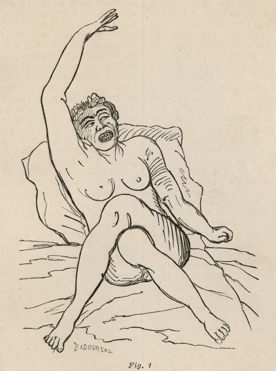 Epilepsia histérica, ataque, contorsiones, fig. 1 de 