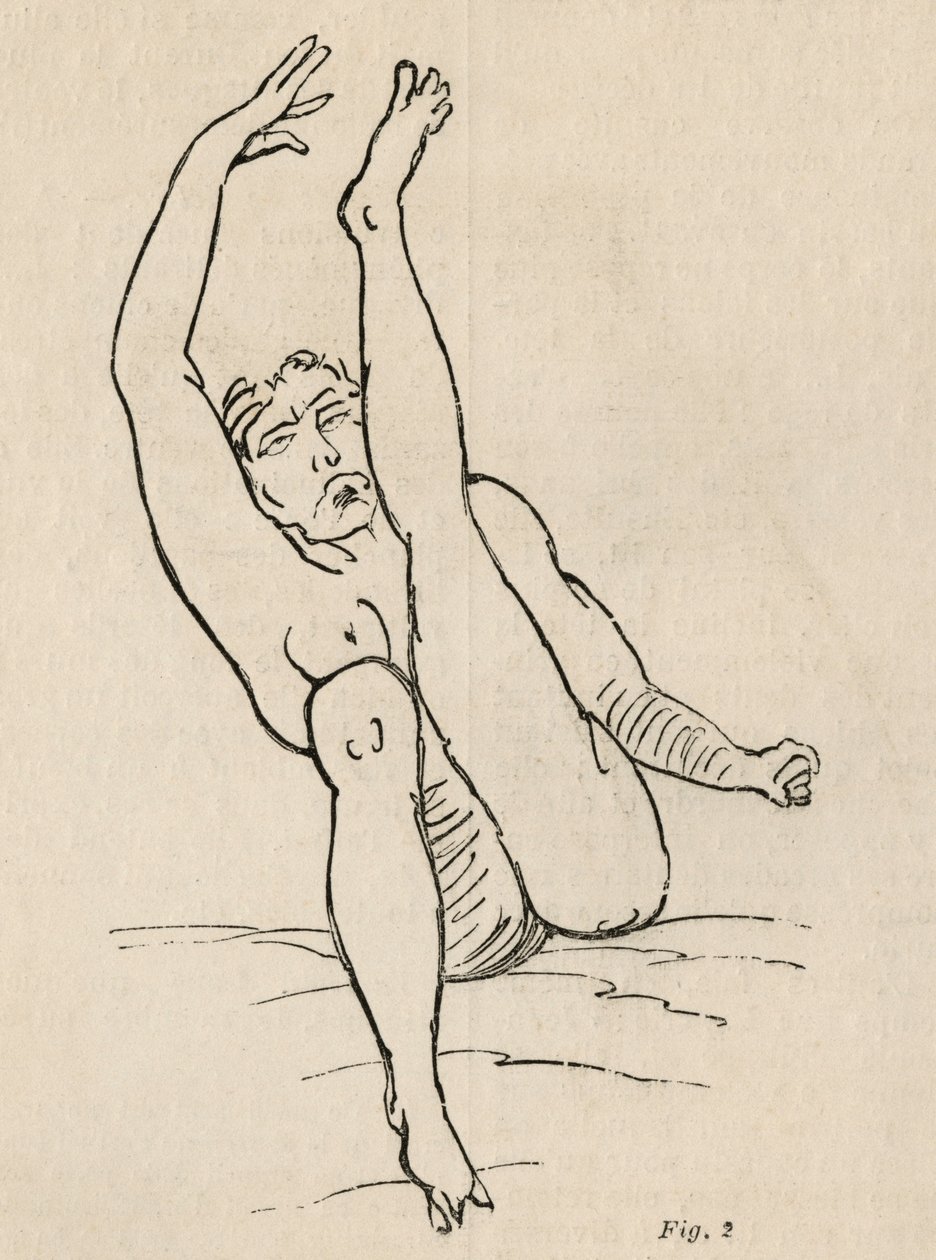 Epilepsia histérica, ataque, contorsiones, fig. 2 de 