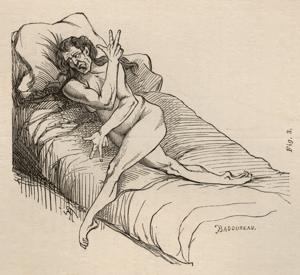 Epilepsia histérica, ataque, contorsiones, fig. 3 de 