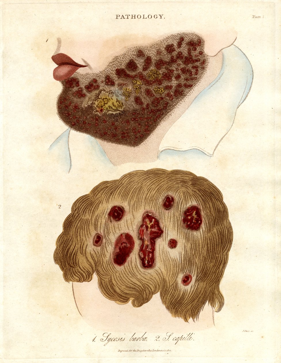 Ilustración patológica de Sycosis barbae y Sycosis capilli de John Pass