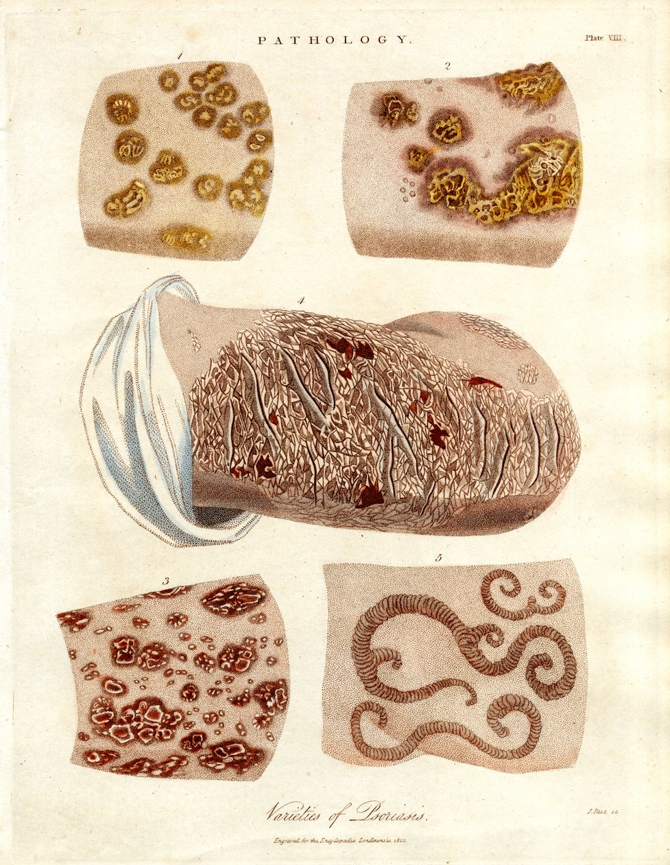 Cambios patológicos de la piel: Variedades de psoriasis de John Pass