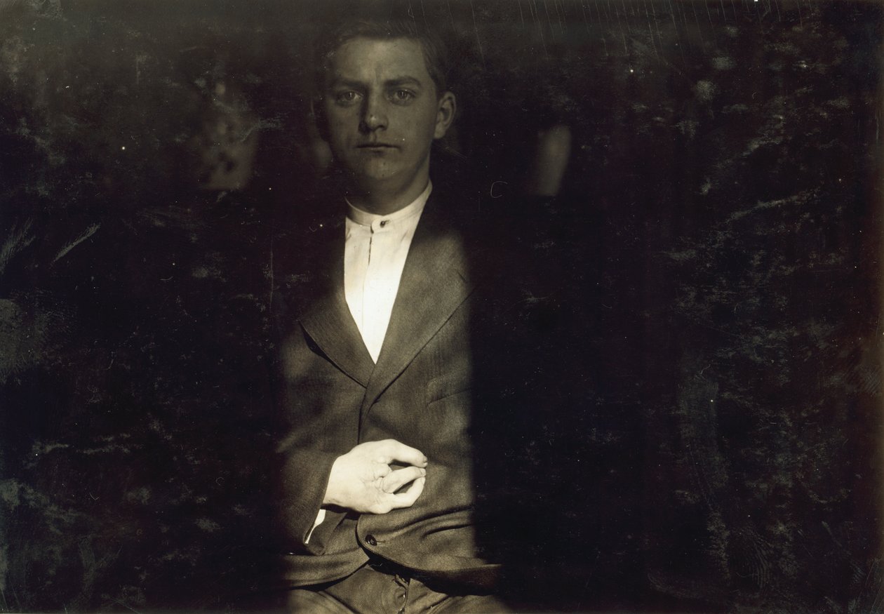 Frank Wiegel, de Brooklyn, herido tras trabajar 18 horas diarias a los 15 años, le amputaron dos dedos de la mano derecha, Nueva York de Lewis Wickes Hine