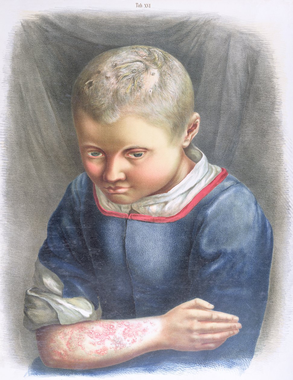 Favus, de un libro de Daniel Cornelius Danielssen, 1892 de Norwegian School
