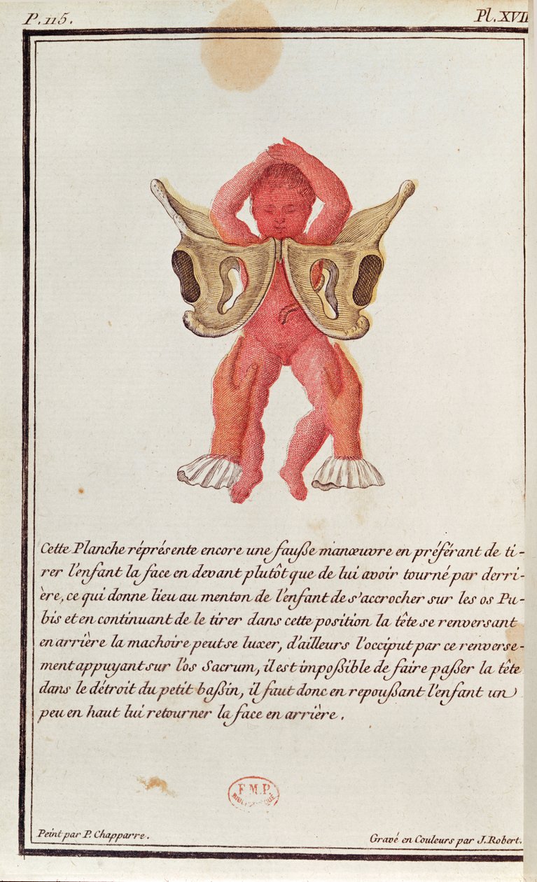 Diagrama transversal de un bebé sacado del útero por las piernas, de un libro de Madame Angelique Le Boursier du Coudray, grabado por J. Robert, 1783 de P. Chapparre